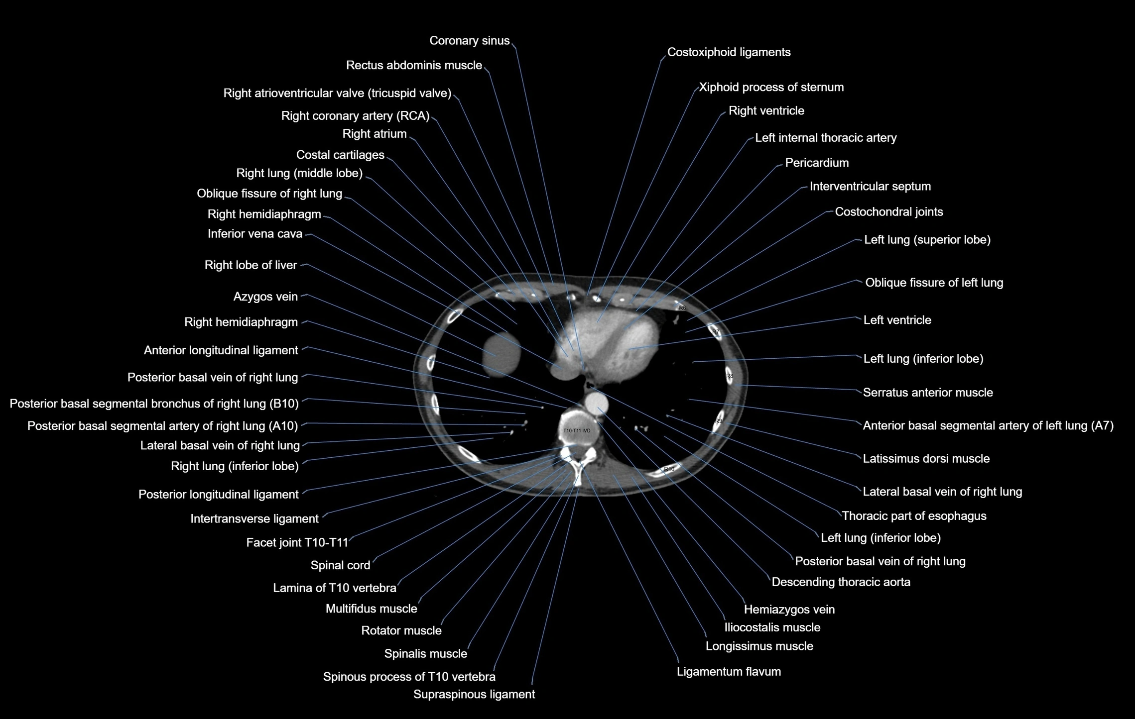CT chest (thorax) soft tissue window labelled axial cross sectional anatomy radiology image-00094.webp
